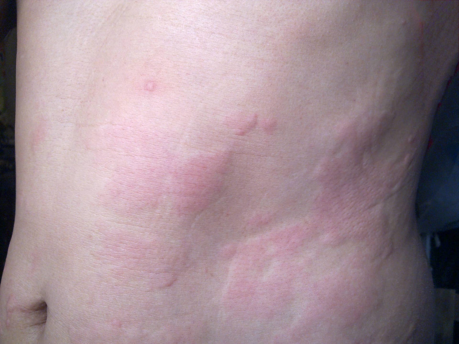 How Tell If Your Rash Is Contact Dermatitis, Eczema, Psoriasis Or Hives ...